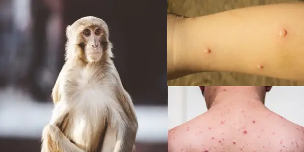 monkeypox maryland